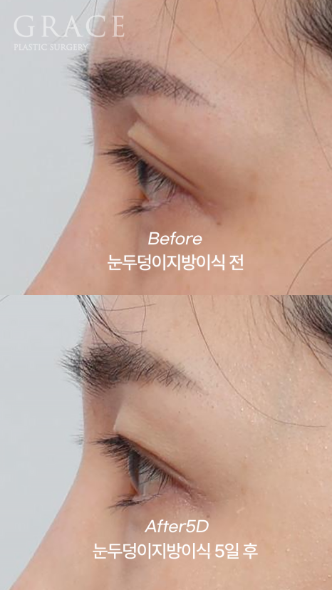 Eyelid Fat Grafting Bruising and Swelling Side Effects (Natural Eyelid Line After 5 Days) image 7