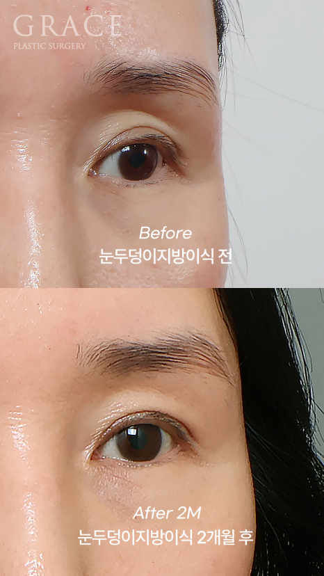 Why Do Hollow Eyelids Occur, and How Can They Be Naturally Improved? (Research Notes from a Doctor Performing Eyelid Fat Grafting) image 5