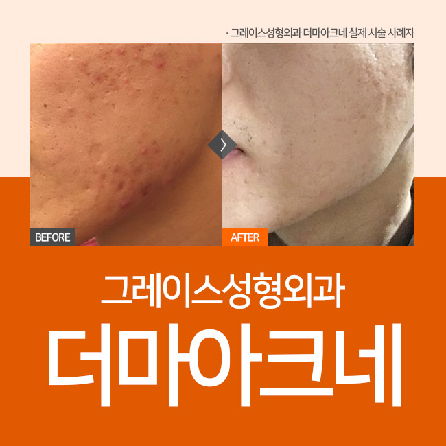 더마아크네로 여드름치료 그리고 재발 예방까지 관련 이미지 1