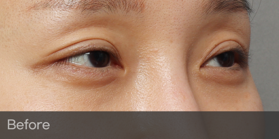 Fatigue-Looking Eyes? Eyelid Fat Grafting image 2