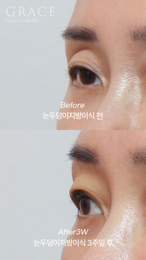Celebrities with Sunken Eye Hollows, Filler Issue? Upper Eyelid Fat Grafting image 3