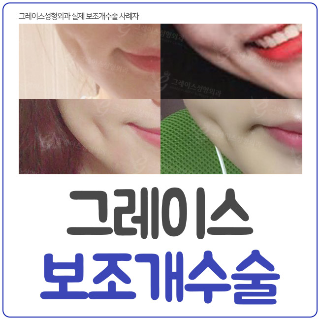 웃을 때 예쁜 포인트를 주는 보조개수술 관련 이미지 2