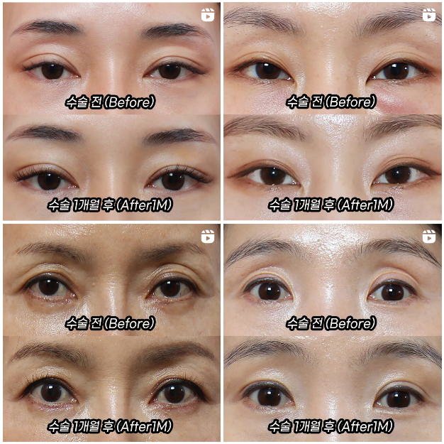 Before and After Eye Hollow Fat Grafting image 2