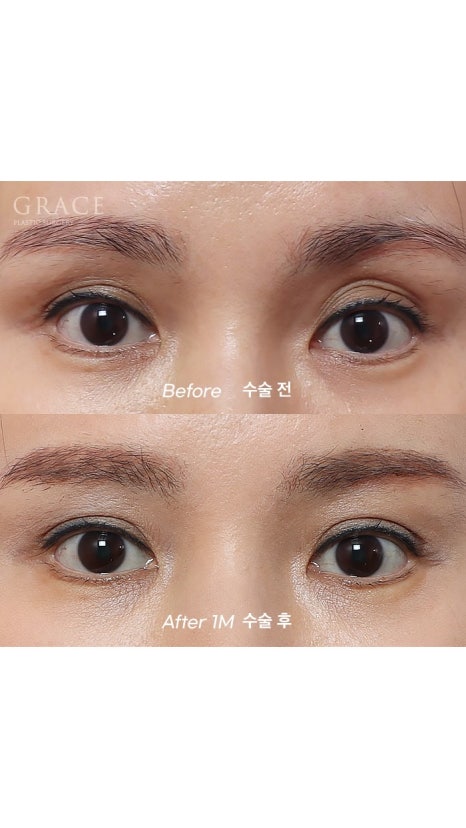 Eyebrow Hollow Fat Grafting Before and After Comparison – Gently Filling Sunken Eyes image 2
