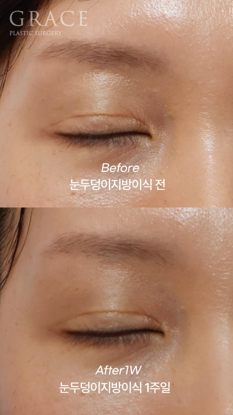Fat Removal After Double Eyelid Surgery? Eyelid Fat Grafting After Double Eyelid Surgery Before & After image 6