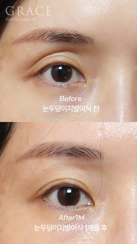 Hollow Eye Holes + Under-Eye Puffiness → (Upper Eyelid Fat Grafting + Fat Repositioning) image 3
