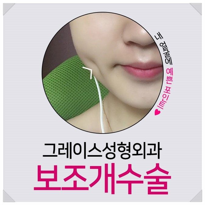 미소부터 달라 보여, 보조개수술후기 관련 이미지 4