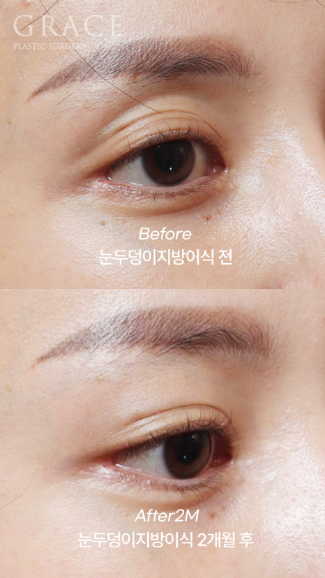 Eyebrow Fat Grafting &middot; Eyelid Fat Grafting &middot; Sunken Eyes Surgery Cost Information (As of June 2025) image 11