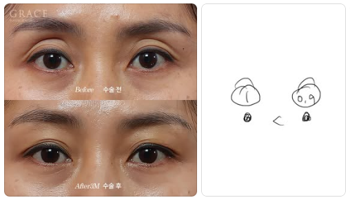Complications from Sunken Eyelid Fat Grafting? The Injection Location Determines the Result image 4