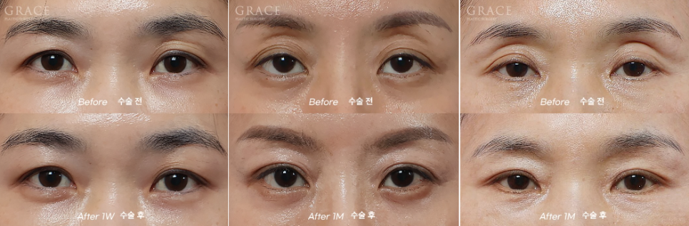 The Most Frequently Asked Symptom After Eyelid Fat Grafting: Yellow Bruising on the Eyelids image 6