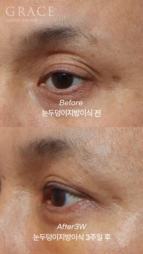 When the Eye Hollows Sink In, You Look Tired: Swelling After Fat Grafting for Men’s Eyes image 5