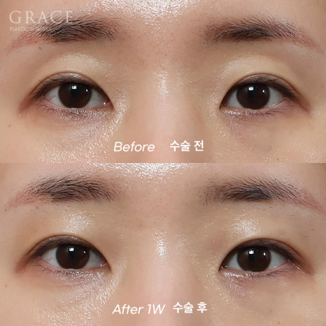 Why Choose Upper Eyelid Fat Grafting Instead of Eye-Hollow Filler? image 10