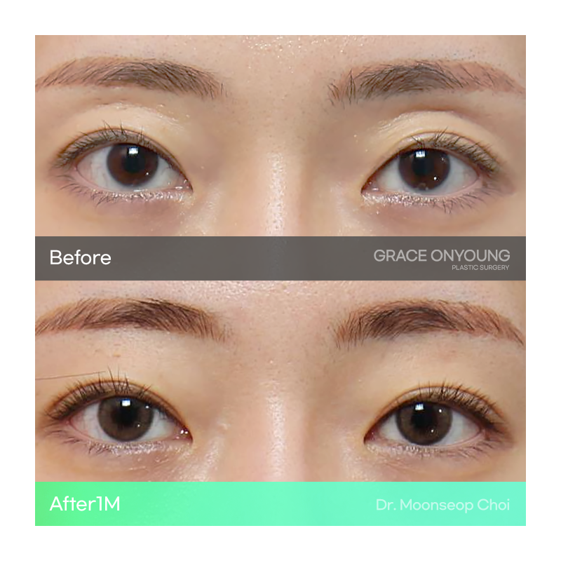 Shocked After Hearing That My Hollow Eyes and Sunken Eye Holes Were Severe? Upper Eyelid Fat Grafting image 4