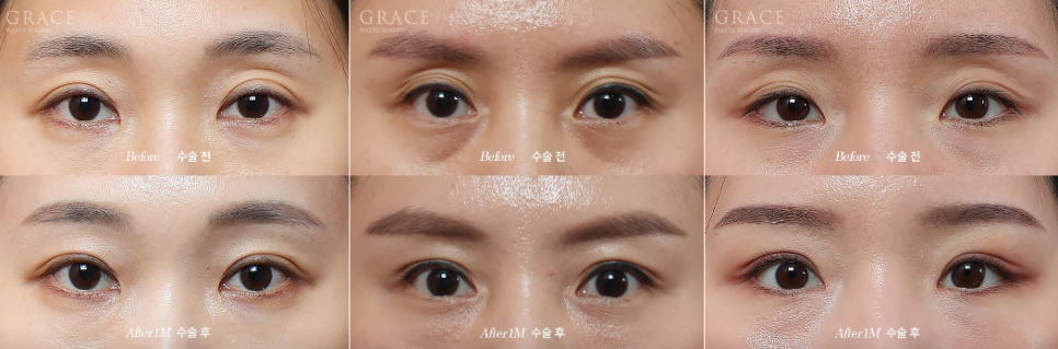 Before and After Eyelid Fat Grafting for Sunken Eye Hollows | Grace Plastic Surgery image 3