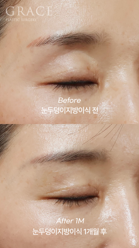 Eyelid Fat Grafting Side Effects? How to Settle In Beautifully Without Lumps image 6