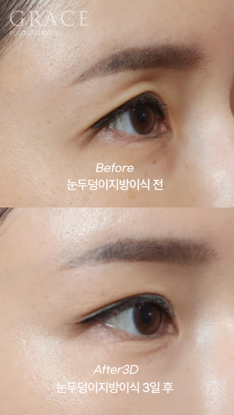 눈두덩이 지방이식 다운타임? 3일 후 흉터&middot;멍&middot;붓기 보여드립니다. 관련 이미지 4