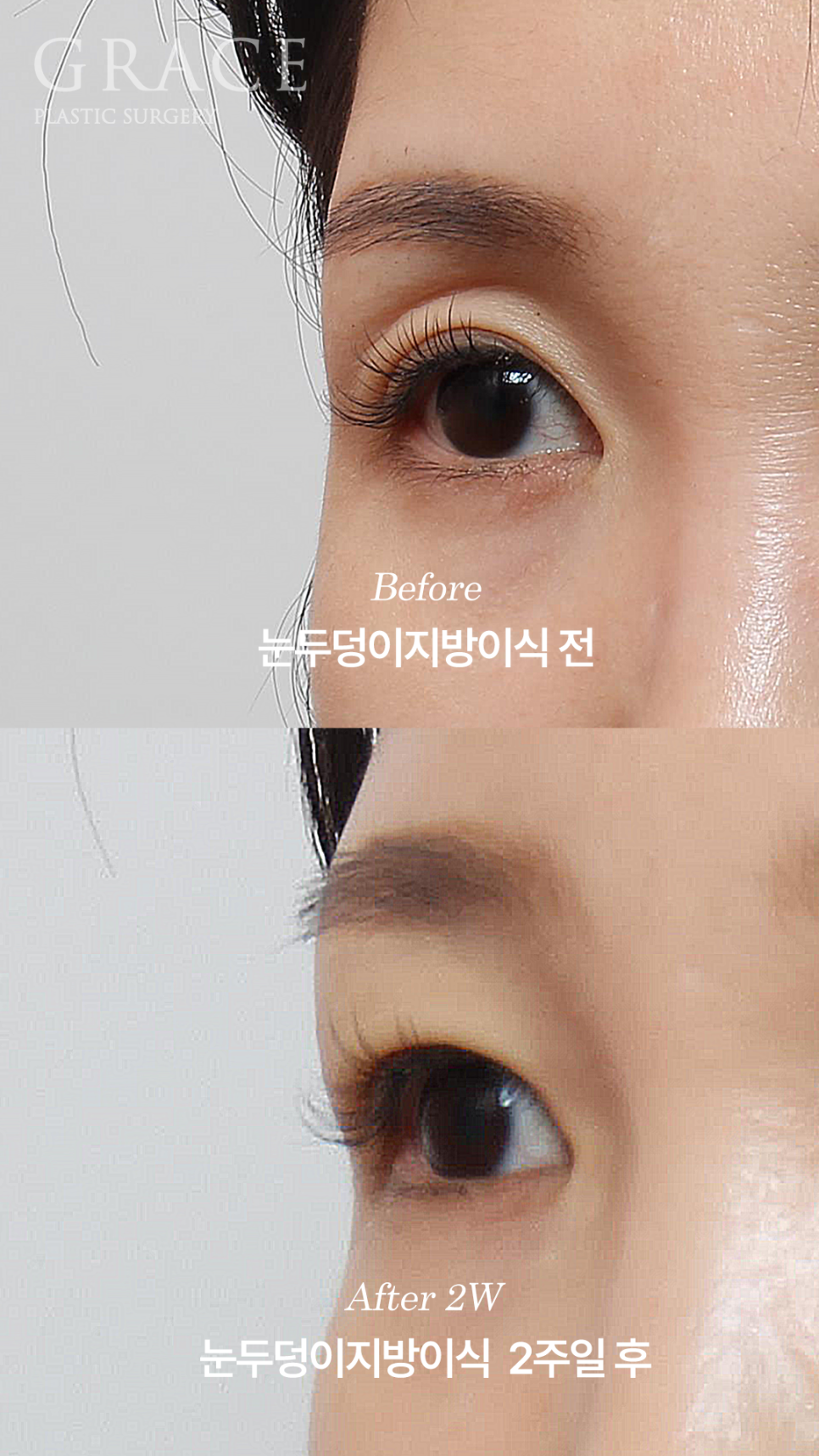 Double Eyelid Fat Grafting Fails When It Becomes Visible and Bumpy? image 4