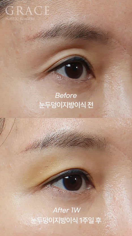 One-Week Changes After Eyelid Fat Grafting: Sunken Eye Hollows Regain Volume image 7
