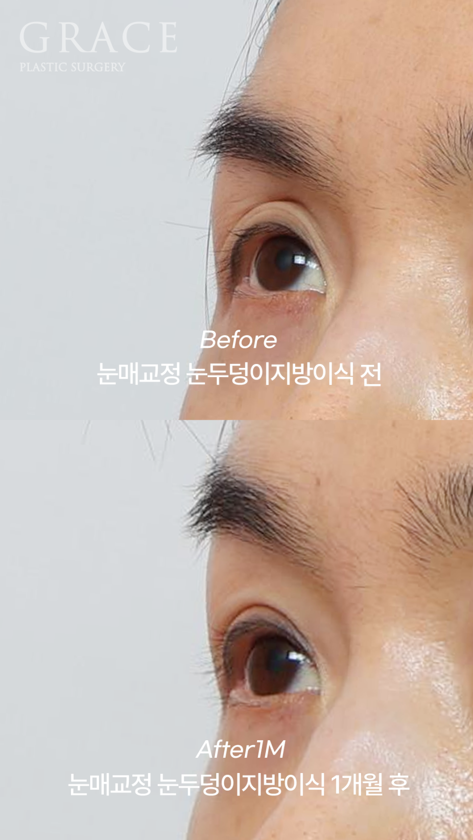 Sunken Upper Eyelids: Fillers or Fat Grafting? image 4