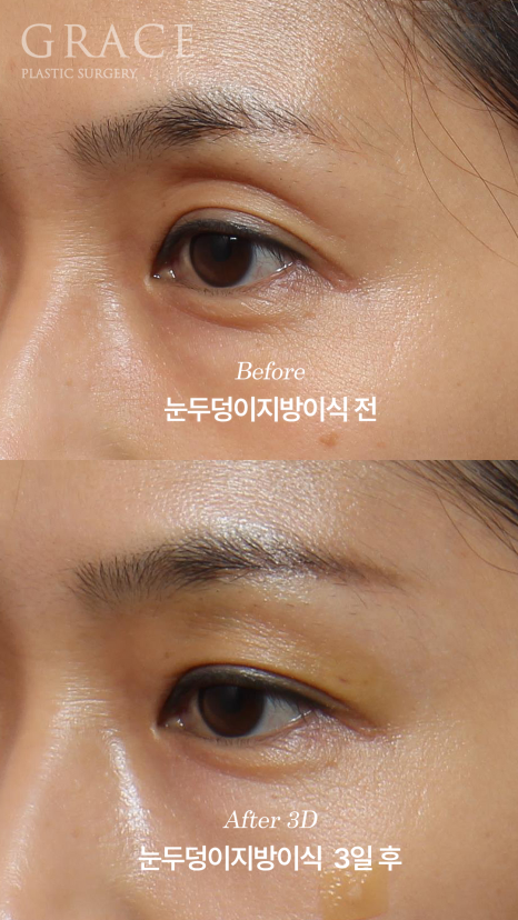 The Most Frequently Asked Symptom After Eyelid Fat Grafting: Yellow Bruising on the Eyelids image 4