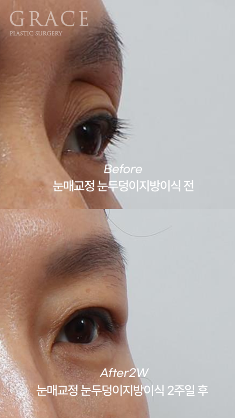 2-Week Swelling Progress After Upper Eyelid Fat Grafting + Incisional Ptosis Correction in Your 40s image 6