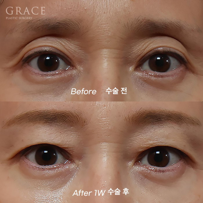 눈두덩이 지방이식 유지기간과 부작용까지 한 번에 정리 관련 이미지 1