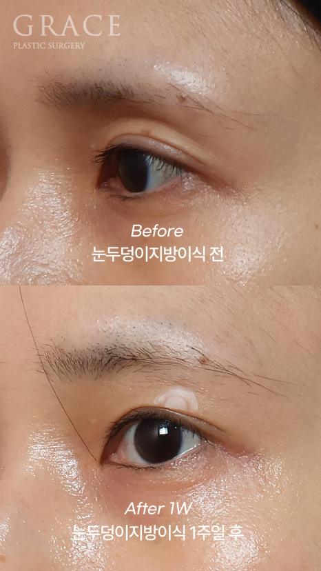 눈꺼풀 지방이식 눈 감았을 때 울퉁불퉁하지 않는 이유 전후사례로 보여드립니다 관련 이미지 5