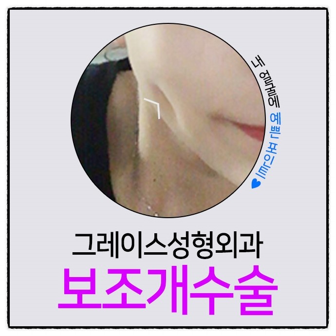 보조개수술후기 보고 심쿵한 매력♡ 관련 이미지 2