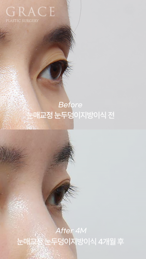 Review of 1cc Eyelid Fat Grafting for Sunken Upper Eyelids (Mid-30s, 4 Months Post-op Swelling and Scarring) image 5