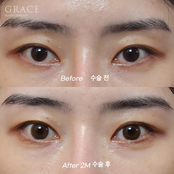 Understanding the Difference Between Forehead Fat Grafting (Eye Hollow Fat Grafting) and Fillers image 6
