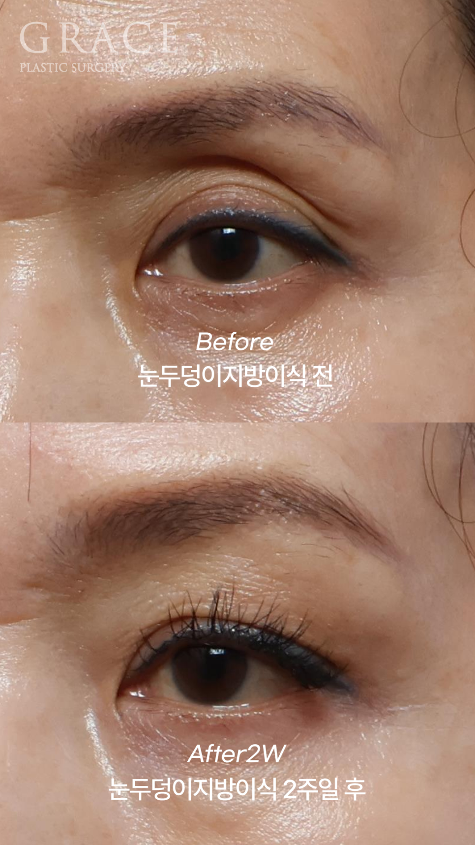 50대 눈꺼풀 지방이식 잘하는곳 염려되는 부작용 걱정까지 관련 이미지 3