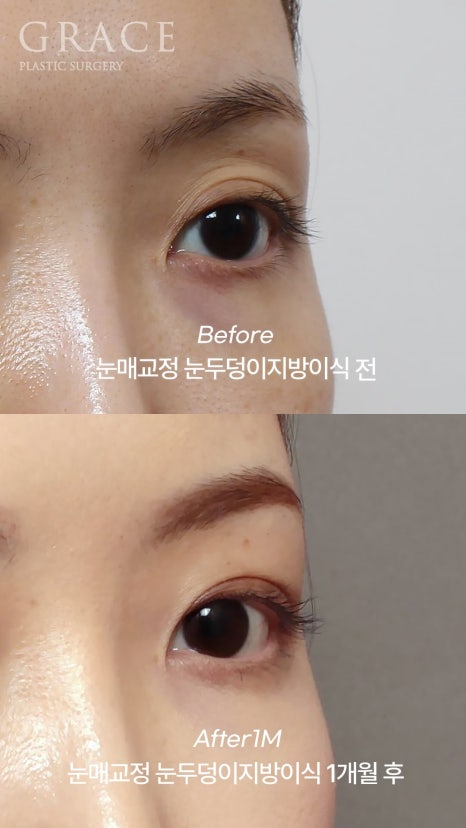 Eyebrow Hollow Fat Grafting Before and After Comparison – Gently Filling Sunken Eyes image 20