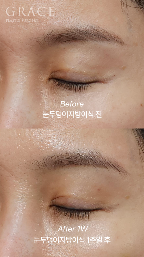 One-Week Changes After Eyelid Fat Grafting: Sunken Eye Hollows Regain Volume image 11