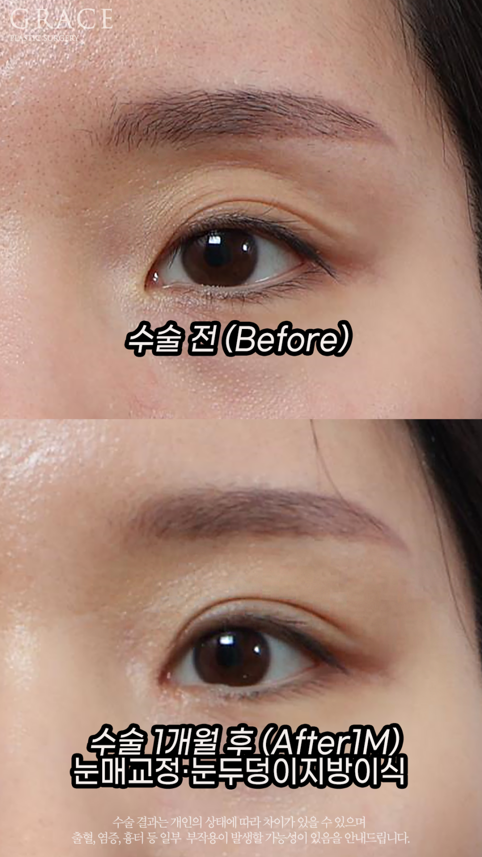 Before and After Upper Eyelid Fat Grafting for Women in Their Early 30s image 2