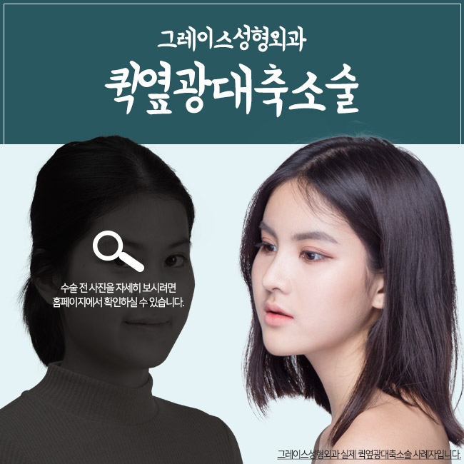 Quick Cheekbone Reduction Surgery Review for a Smooth Facial Line! image 3