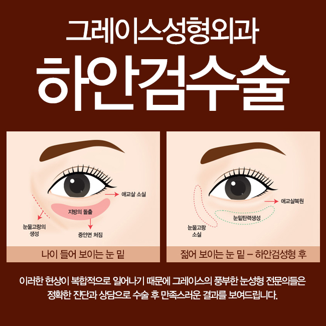 만족스러운 결과! 하안검수술후기 관련 이미지 2