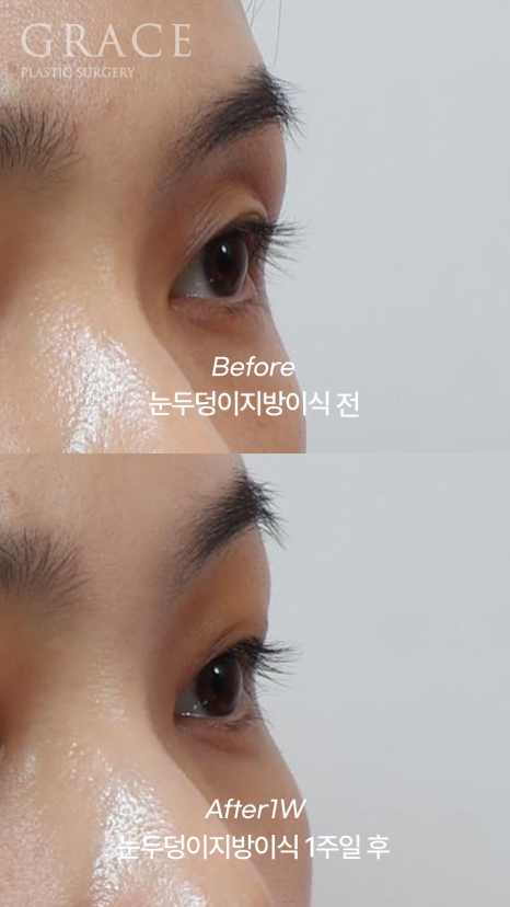 1 Week After Forehead Fat Grafting for Sunken Eyes: Honest Swelling Update image 4