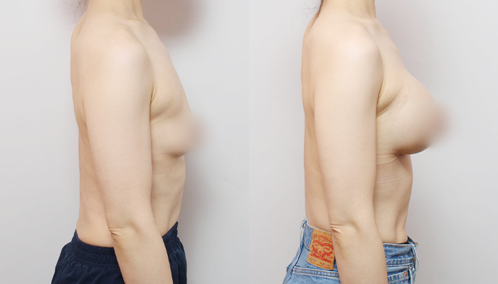 Considering Breast Augmentation Options? A Comparison of Dual Plane vs. Tissue-Preserving (Partial Subfascial) Techniques image 2