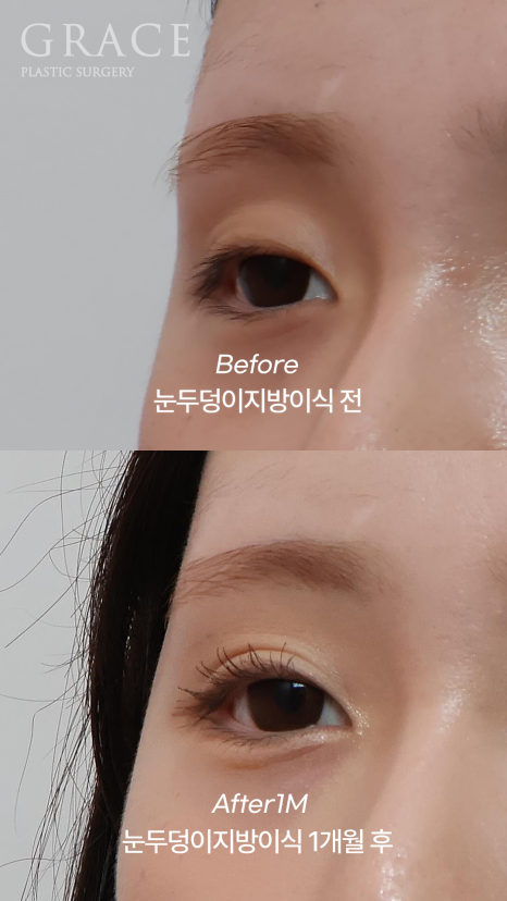 In Your Mid-20s, If You Have Ptosis Before and After Upper Eyelid Fat Grafting, Is Eye Correction Essential? image 6