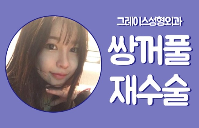 성공적인 쌍꺼풀재수술, 그레이스성형외과 관련 이미지 3