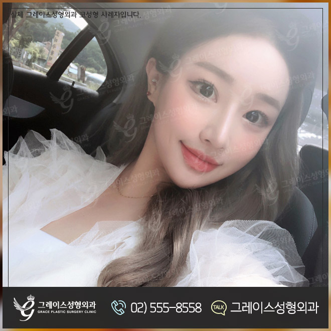 주먹코수술 엣지있게 예뻐지자! 관련 이미지 10