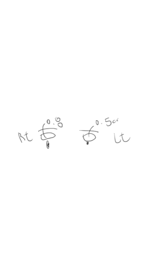 아이홀 꺼짐은 MZ도 예외 없다 눈두덩이 지방이식으로 짝눈교정 관련 이미지 9