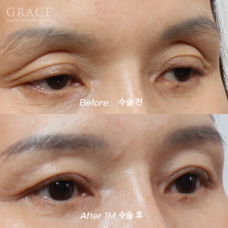 In Your 50s, Restoring a Youthful Look with Before-and-After Eye Surgery and Fat Grafting to the Upper Eyelids, Temples, Under-Eyes, and Above the Brows image 10