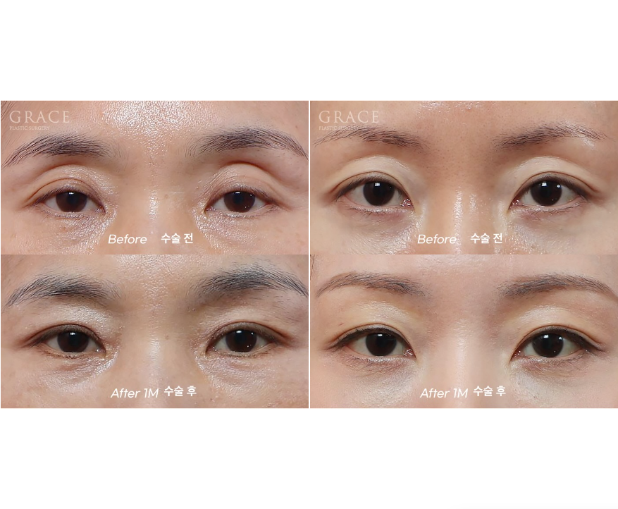 What Matters More Than Swelling After Eye Hollow Fat Grafting: Injection Location and Survival image 3