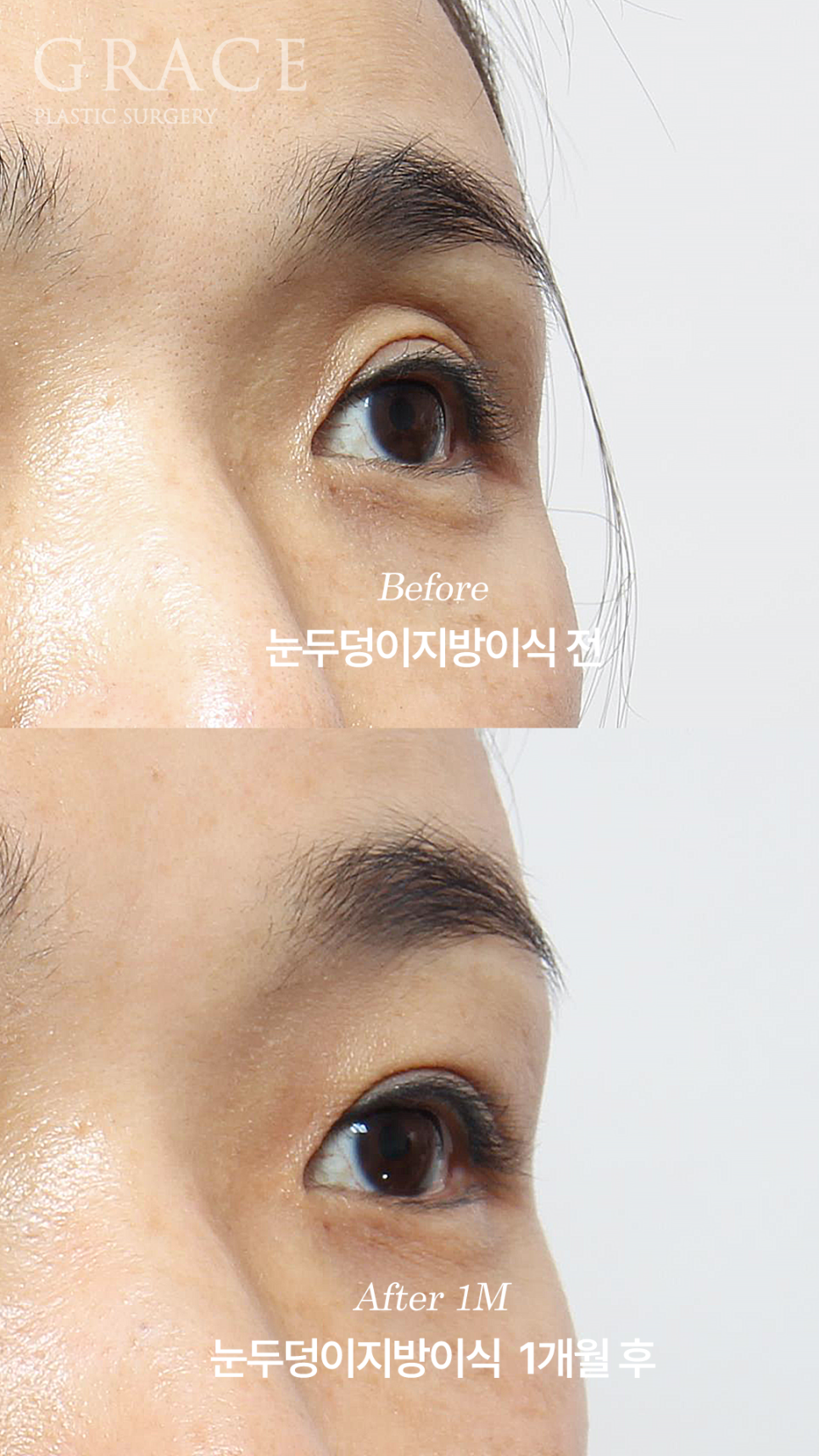 그레이스성형외과 눈두덩이 꺼짐 지방이식 전후 비교 관련 이미지 5