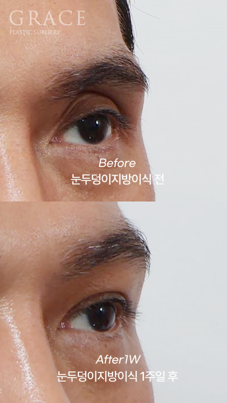 Male Brow Filler? Improvement with Eye-Hole Fat Grafting (Without Worrying About Side Effects, Scars, or Swelling) image 6