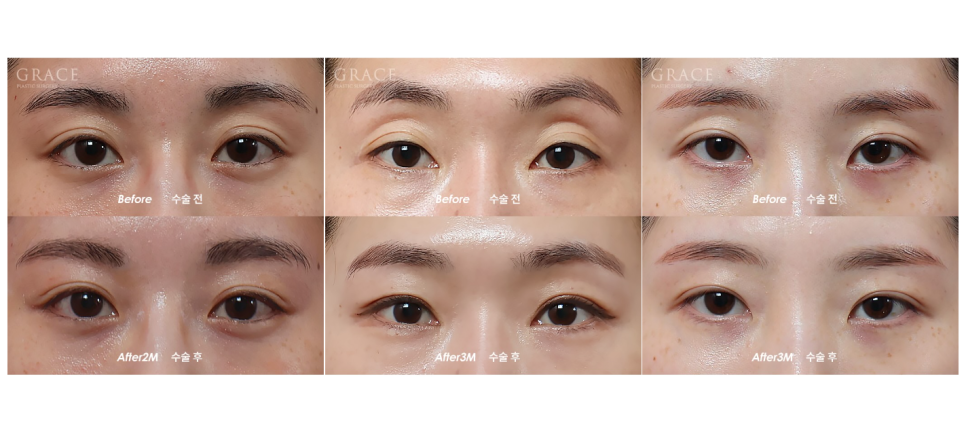 If You’re Curious About Eyelid Fat Grafting Reviews, Costs, Prices, and Side Effects image 4