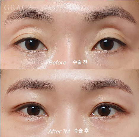 Grace Plastic Surgery’s Approach to Diagnosing Hollow Eye Socket Fat Grafting from the Structure image 1