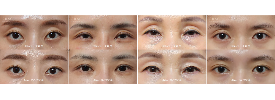 No to Frozen Fat That’s Completely Frozen! Eyelid Fat Grafting with Only Fresh Autologous Fat image 10