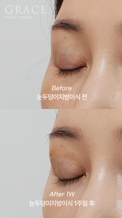 눈 감았을 때 울퉁불퉁? 실제 눈두덩이지방이식 전후 관련 이미지 8